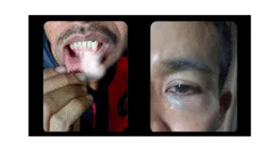 Kondisi wajah salah satu warga adat Maba Sangaji yang tampak mengalami lebam, menurut keterangan keluarga akibat insiden di Rutan Soasio. Hingga berita ini dirilis, pihak rutan belum memberikan keterangan resmi.