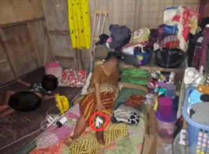 Korban Kecelakaan di Morotai Mengaku Ditekan Saat Teken Surat Damai, Kaki Terancam Infeksi